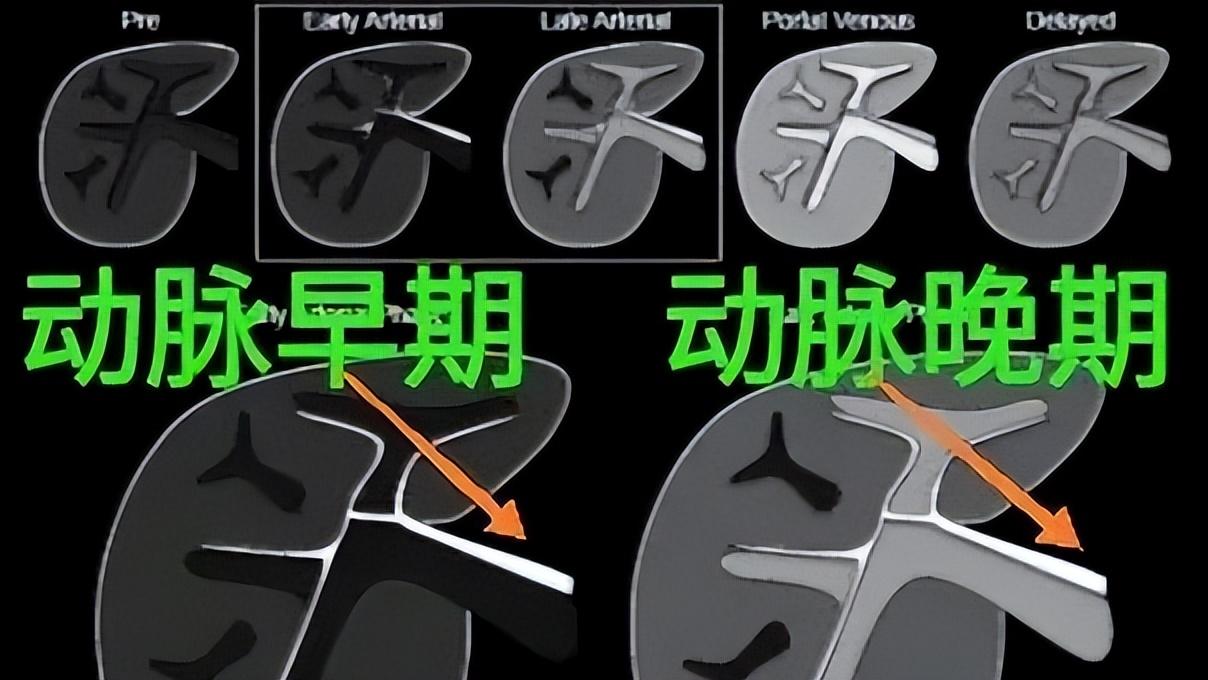 谷丙转氨酶高怎么回事是什么病,谷丙转氨酶高怎么回事严重吗