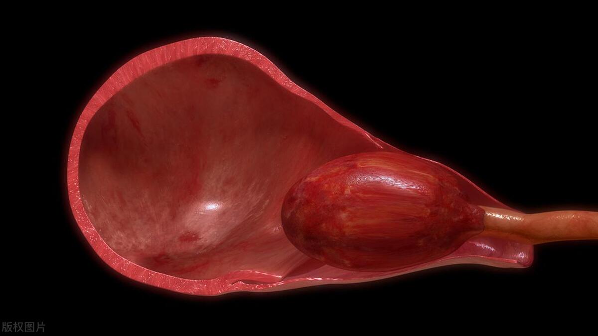 二胎宫颈口撕裂,二胎会阴处撕裂