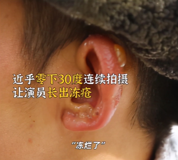 零下20度冻伤男子,男星零下三十度拍戏