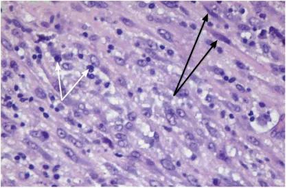 中间型肌纤维母细胞瘤,小孩炎症性肌纤维母细胞瘤