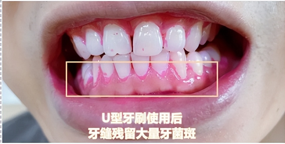 2022飞利浦儿童电动牙刷哪个好用,飞利浦usmile电动牙刷测评