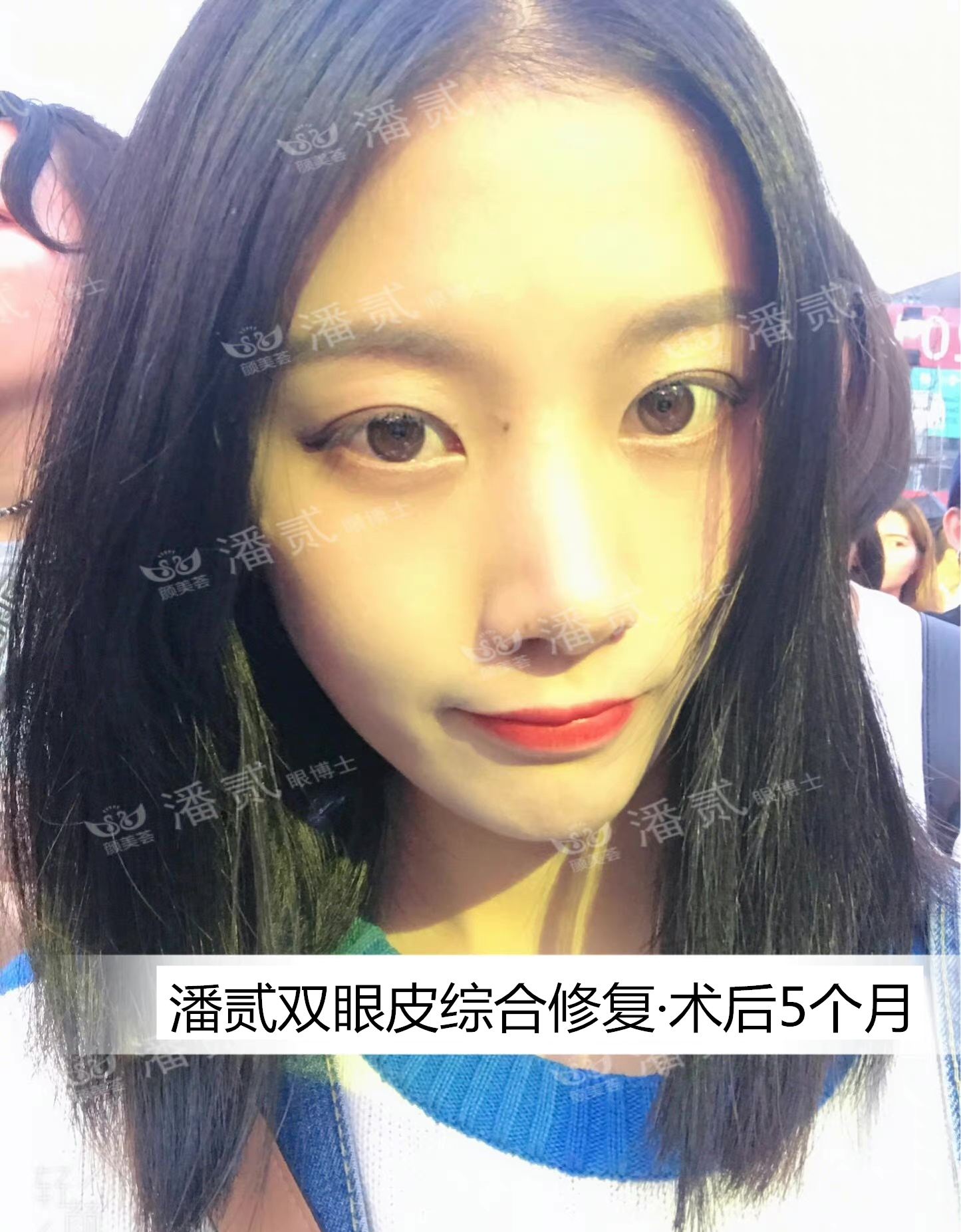 双眼皮贴导致眼皮破了,双眼皮贴导致眼皮严重下垂恢复