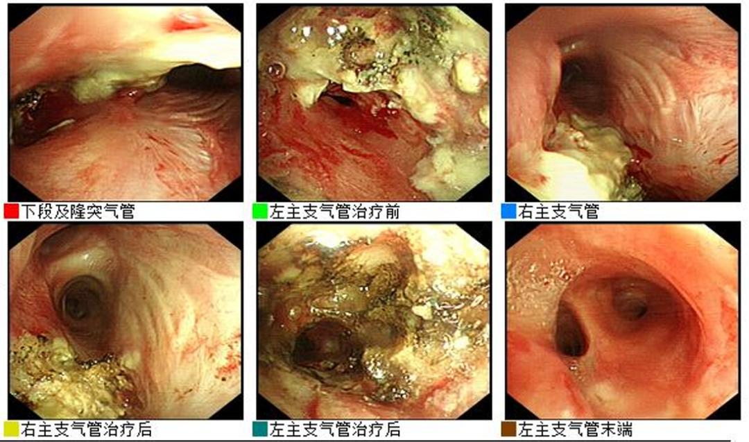 男23岁因上呼吸道感染剧烈咳嗽,34岁小伙咳嗽一个星期了