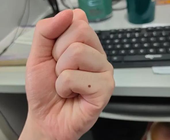 长在身体什么部位的痣容易癌变,脖子突然长痣是癌症的症状