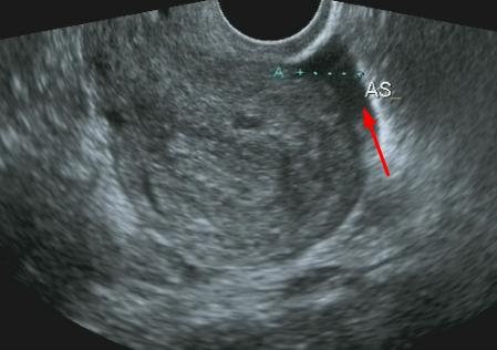 b超能查出盆腔肿瘤吗,B超能查出盆腔炎症吗