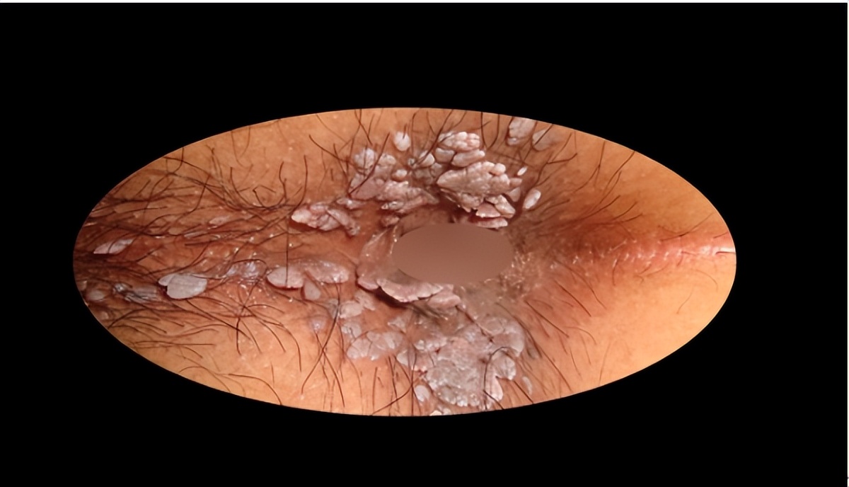 手上、脸上的“肉疙瘩”哪些是HPV导致的？6种常见疣的区分和治疗