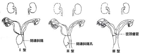 排出两三个卵能否生双胞胎,26岁女子查出双子宫