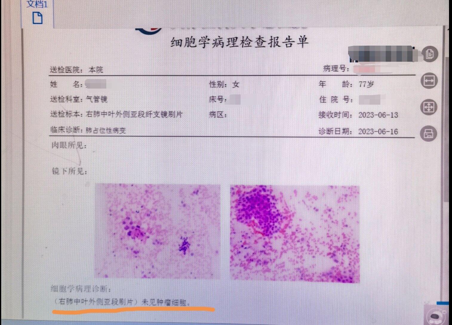 刘懿博士说肺癌不可手术,刘懿说肺癌一般吃什么药