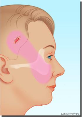 内窥镜拉皮和普通拉皮的区别,内窥镜拉皮除皱