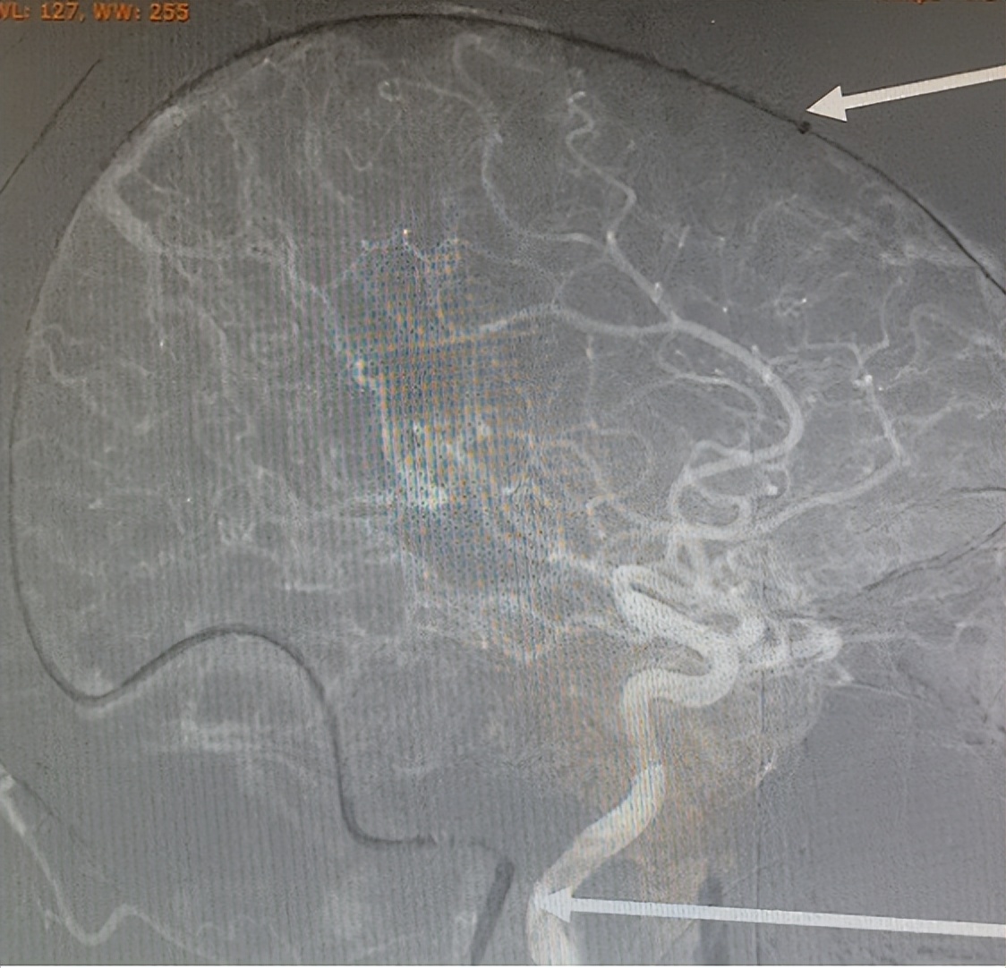 重症监护室救活孕妇故事,急救危急重症孕产妇途中分娩