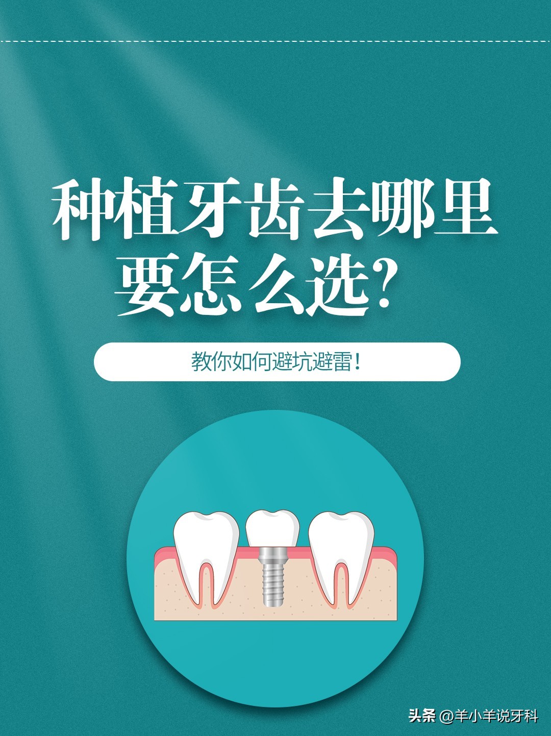 种植牙齿去哪,种植牙齿去哪里做比较好