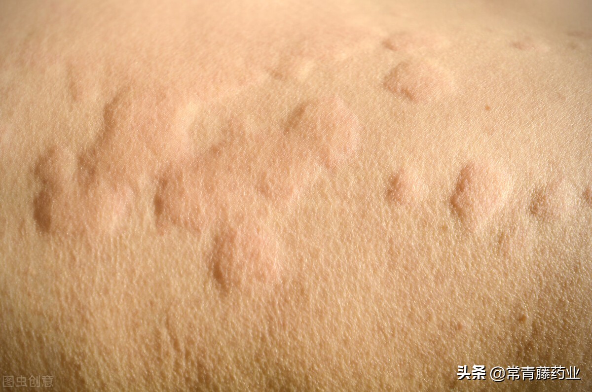 天气好转了寒冷性荨麻疹会自愈么,天气变冷荨麻疹中医病因分析