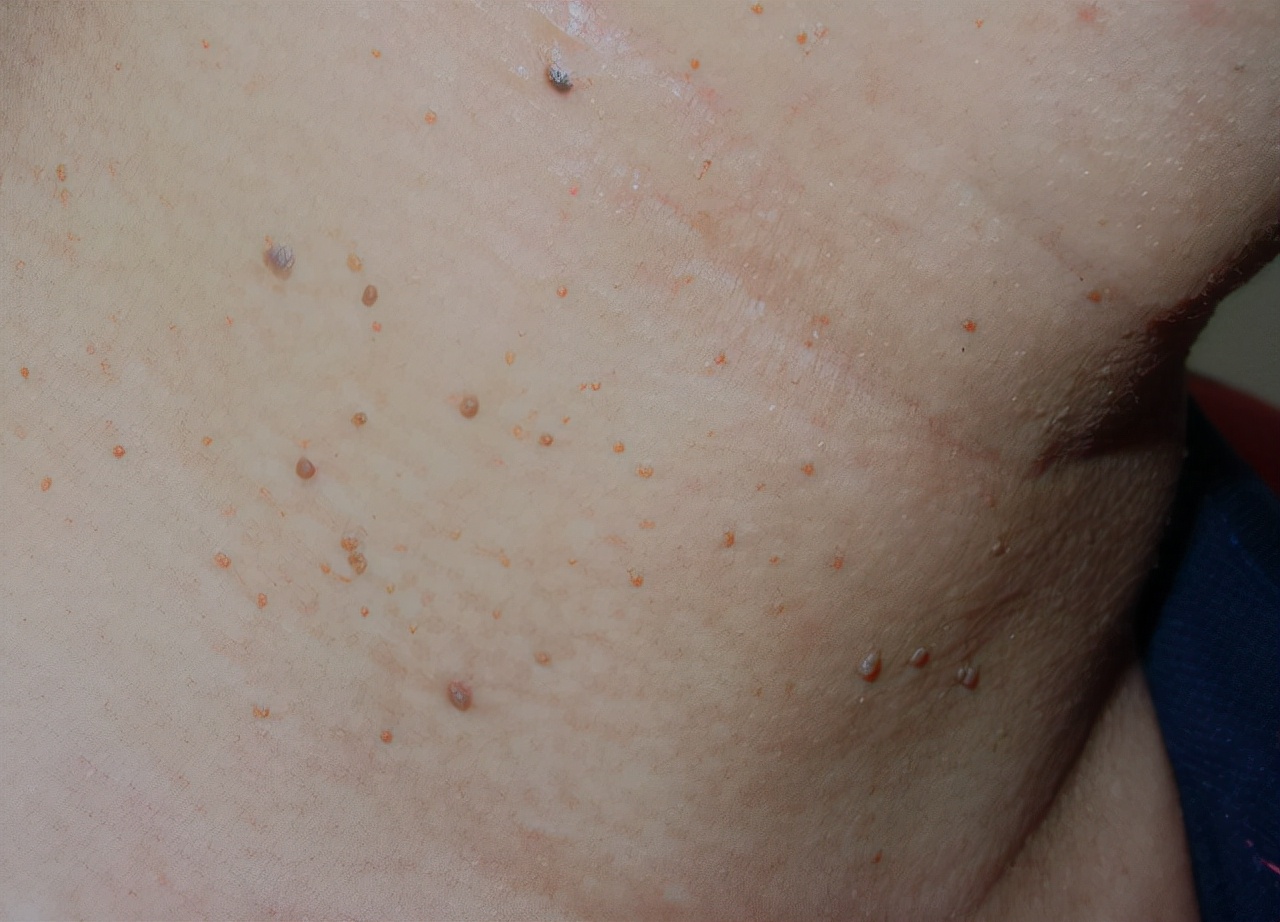 腋下脖子长小颗粒是怎么回事,脖子腋下长小肉粒可以用手揪掉吗