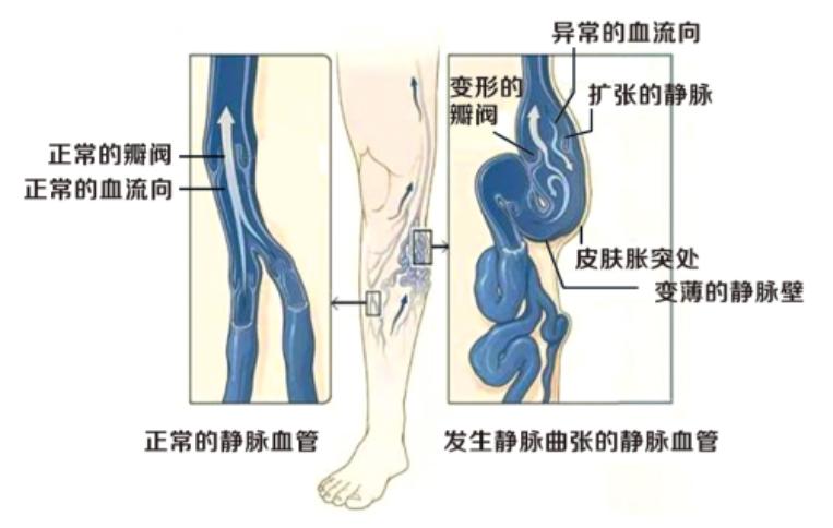 静脉曲张科普创意视频,精索静脉曲张科普动画视频