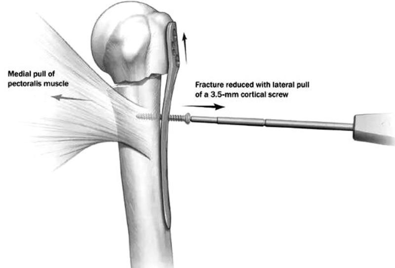 肱骨近端骨折属于几级伤残,肱骨近端骨折康复训练技巧