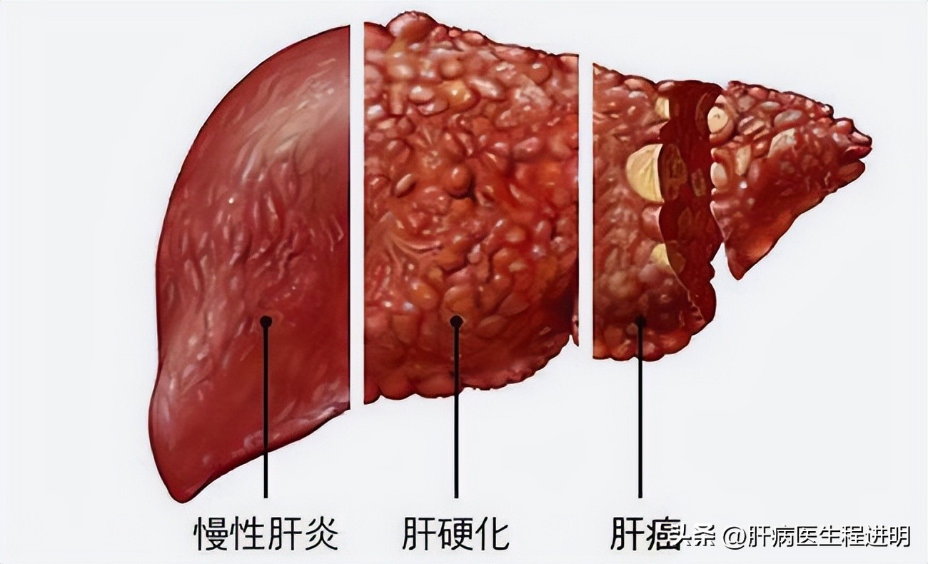 42岁男子连夜确诊肝硬化,男子诊断出肝硬化晚期