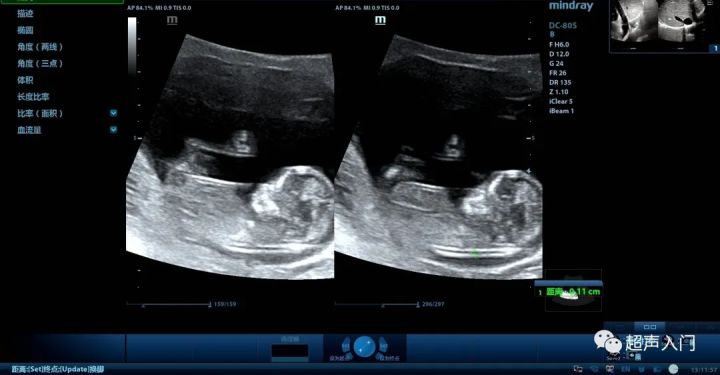 nt检查是阴式还是腹式彩超,nt是做阴超还是腹部超声啊