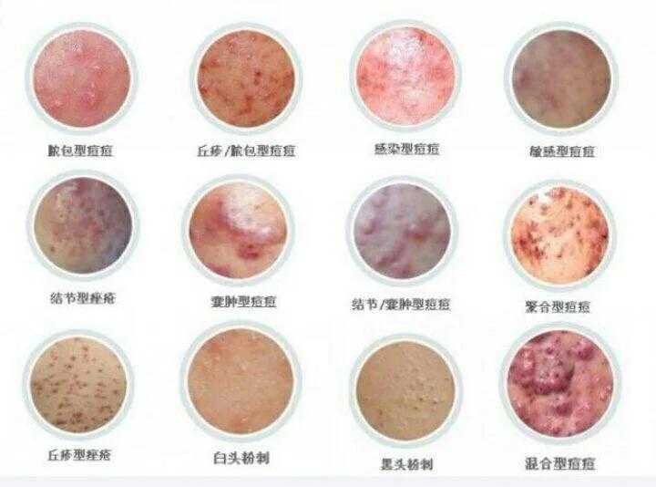 疮痈中医辨证论治,治疮疡的方子