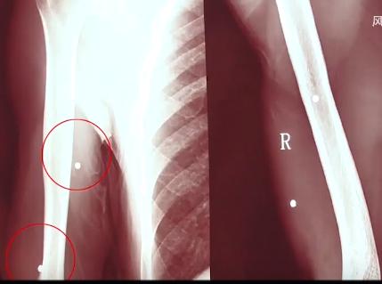 村民夜钓疑被当成野猪,江西夜钓被当野猪打
