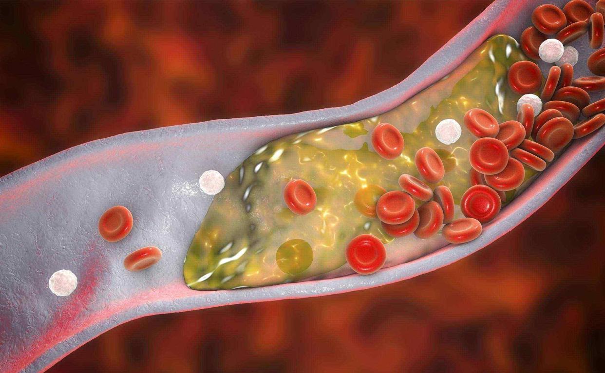 进口他汀和国产他汀价格,进口他汀比国产的副作用小吗