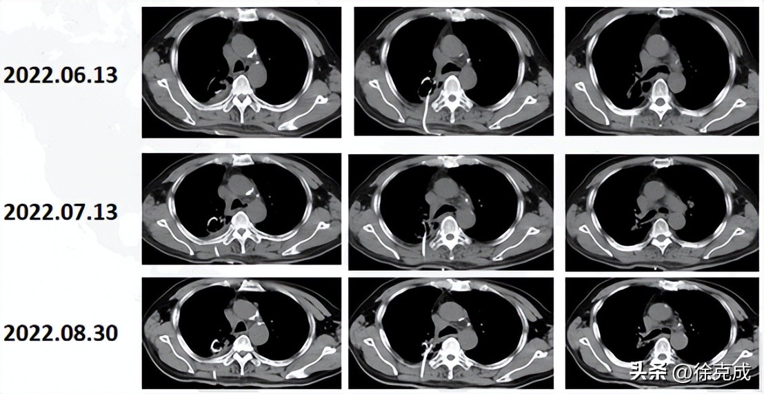 肺癌电场疗法,肺癌吸入疗法