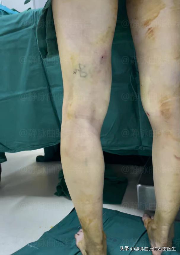 静脉曲张为何血管会像蚯蚓,静脉曲张蚯蚓腿怎么形成的