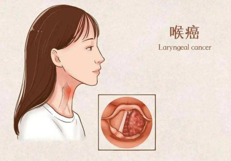 全喉切除术治疗喉癌的缺点,喉癌手术切除后吞咽困难怎么办