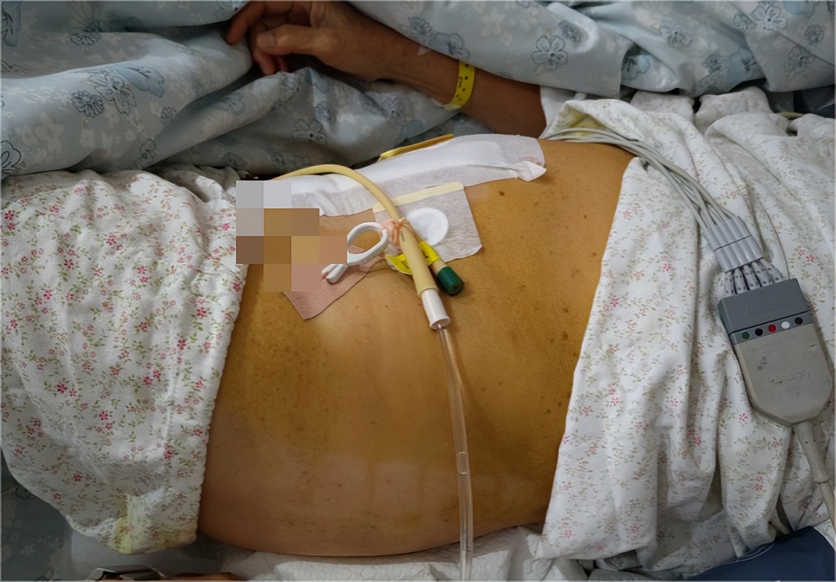 女性肚子增大是真的“肥胖”了吗，其实不然，可能是…….