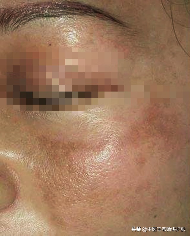 肝肾阴虚长斑怎么去掉,月经少长斑怎样调理