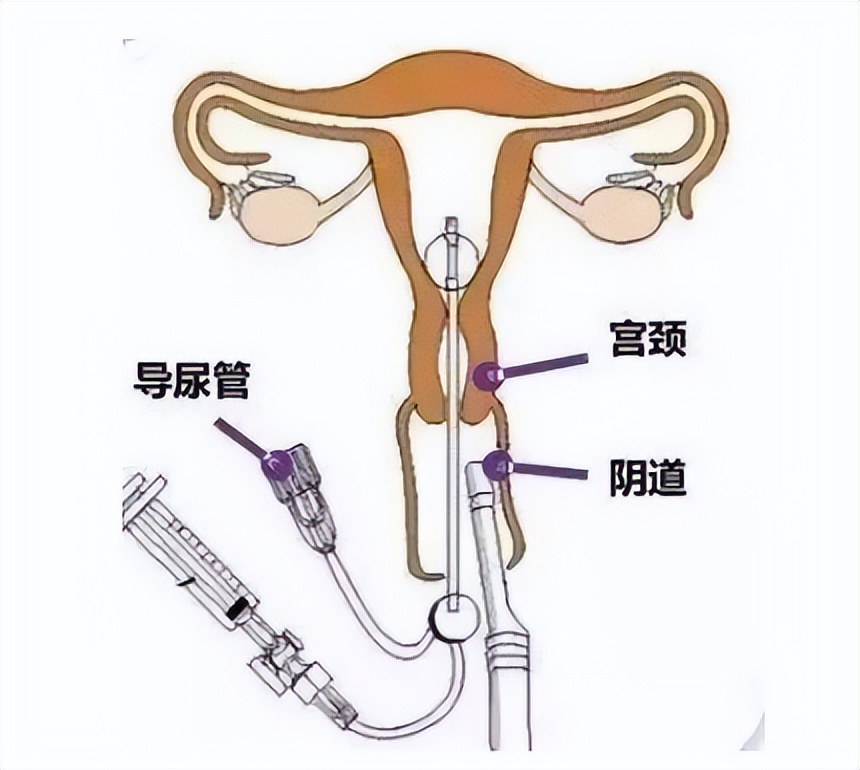输卵管4d超声造影多久可以要孩子,无痛4d子宫输卵管造影