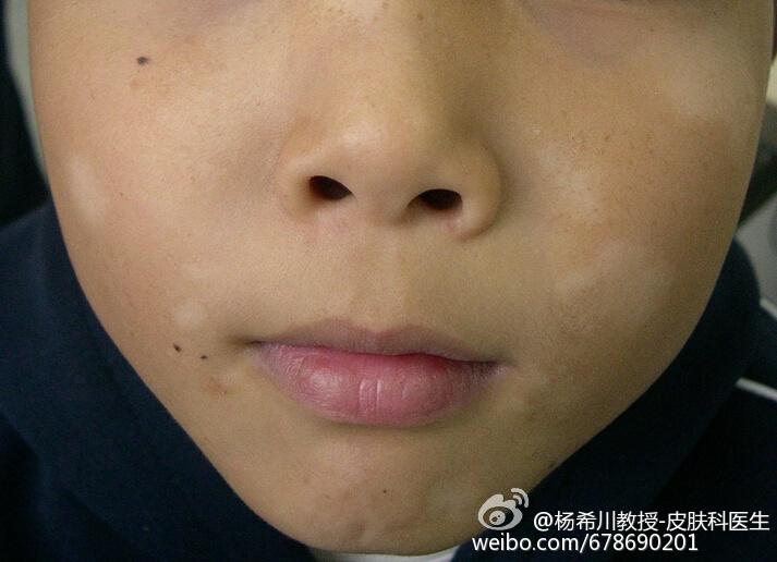 有什么白斑是不用治疗的,白斑怎样治疗才能消失呢