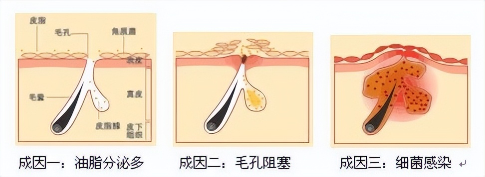 头皮毛孔堵塞怎么疏通毛孔最有效,毛孔堵塞怎么疏通最快最有效