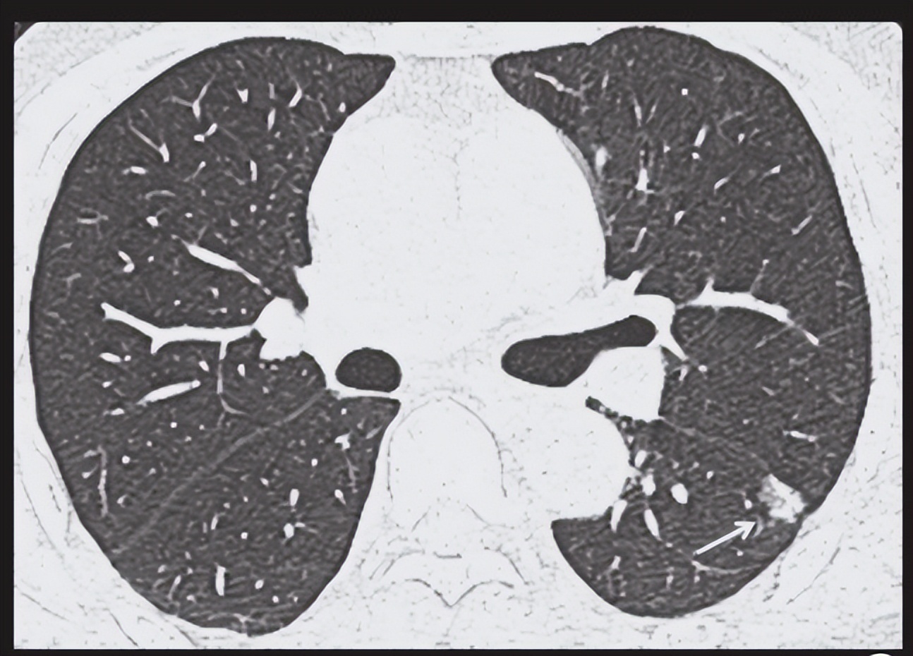 5mm的磨玻璃结节有胸痛症状好吗,胸痛拍ct会检查出病因