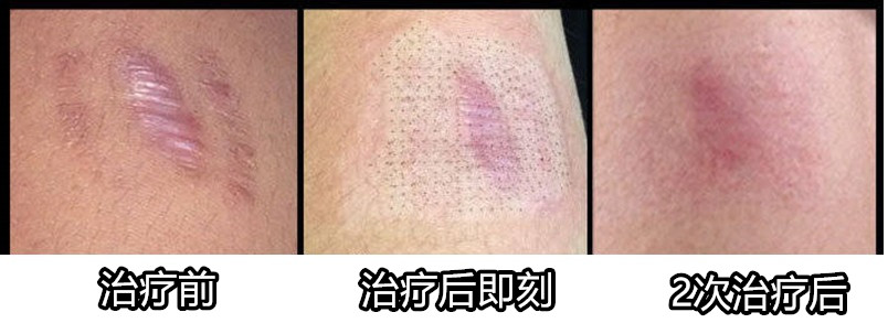 3个月的疤痕增生还能消除吗,莫名其妙长了个增生疤痕