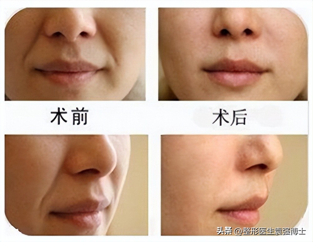 法令纹重就丑吗,法令纹丑了怎么办