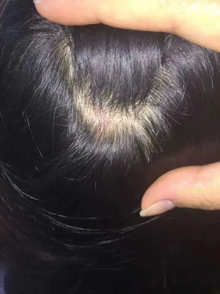 银屑病头皮屑症状中医,银屑病为啥头皮鳞屑厚