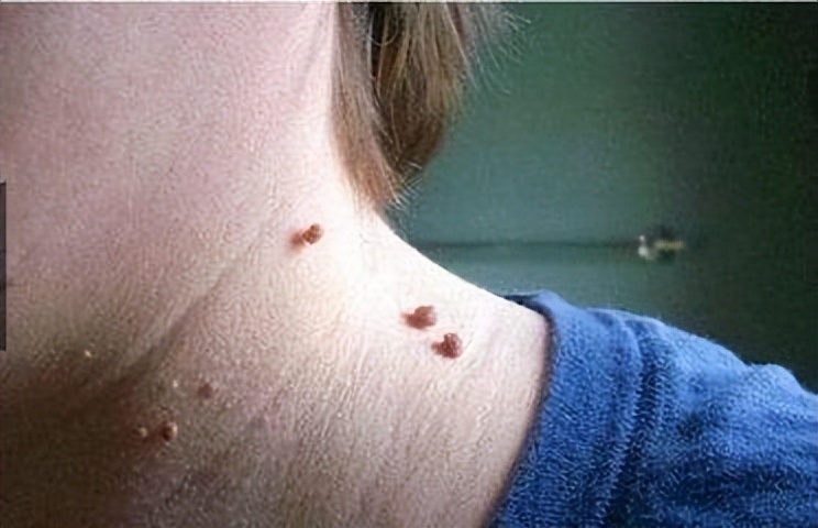 皮肤上长出肉疙瘩怎么办,皮肤上长肉疙瘩如何正确解决