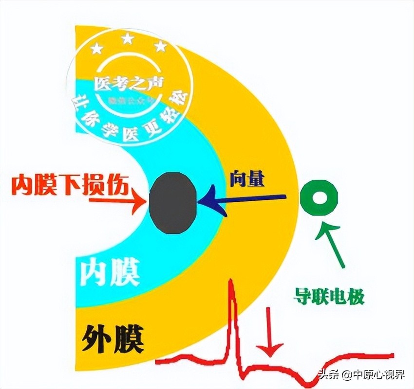护考几种常见的心电图,常见的心电图图形分析