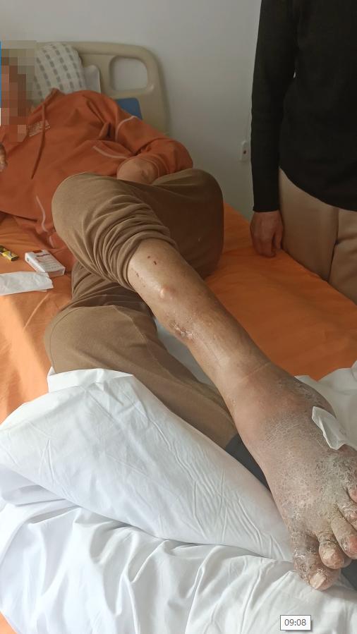 张仲景的痛风方子,张仲景治痛风是真的吗