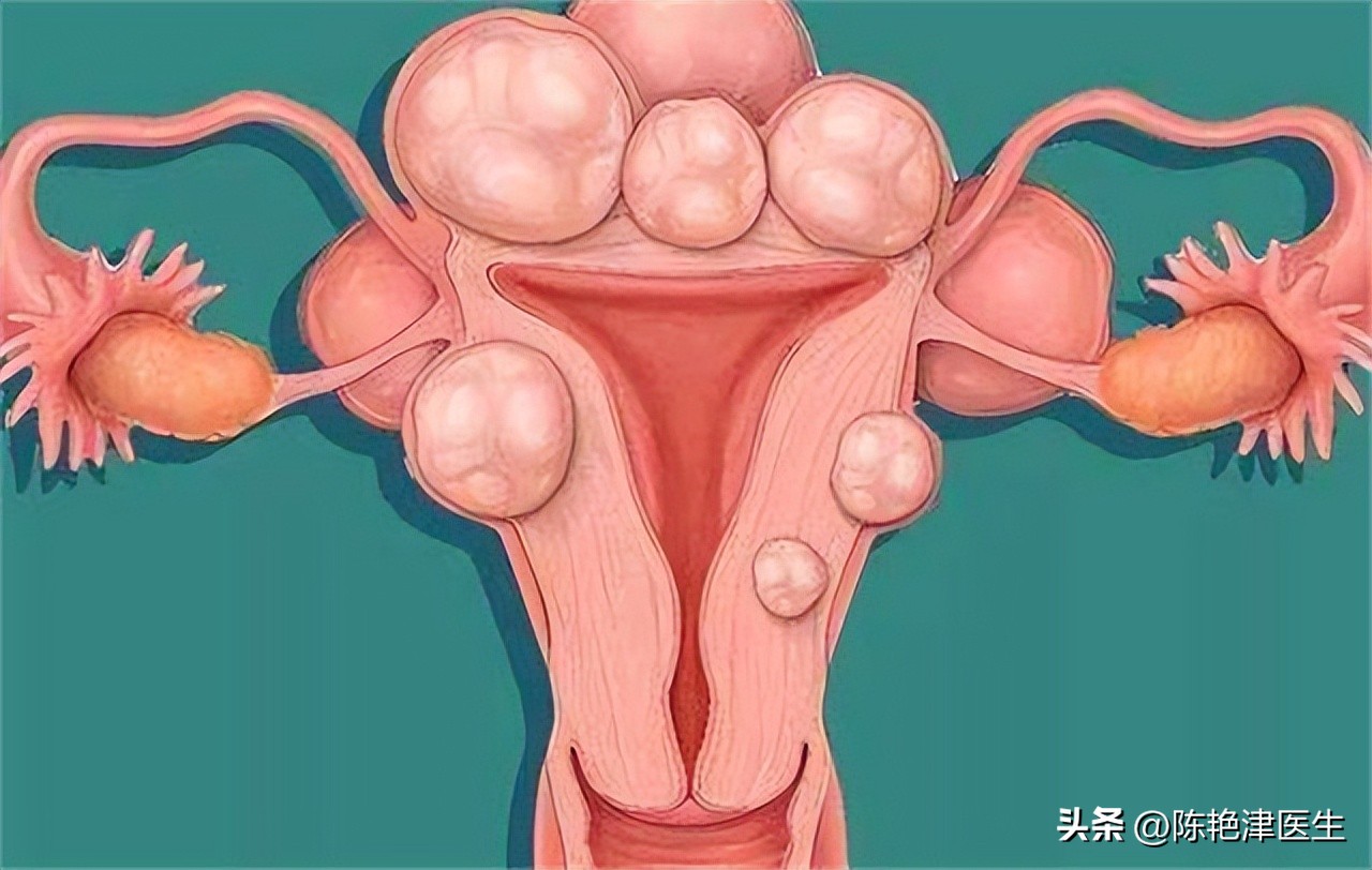女性为什么容易长子宫肌瘤？提醒：平时尽量避免3个行为，别忽视