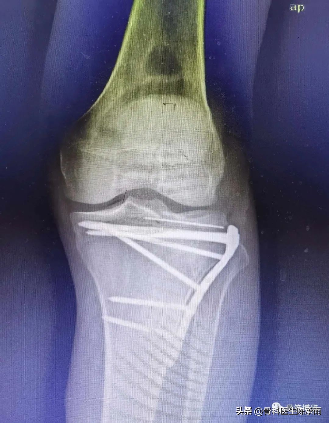 膝关节胫骨平台骨折,最近胫骨平台骨折视频