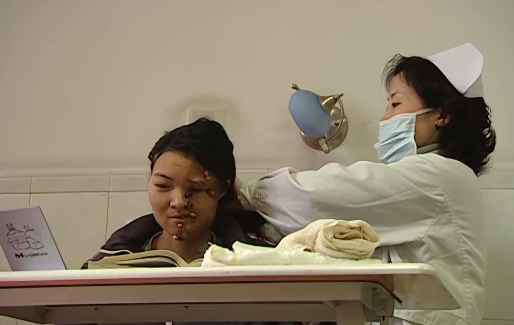 二十岁花季少女毁容手术,重庆15岁花季少女被毁容之后