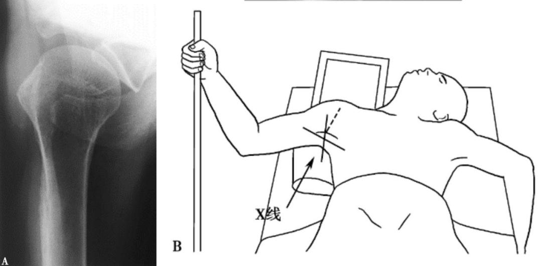 四个注意全面预防骨质疏松,4个要点的剖析