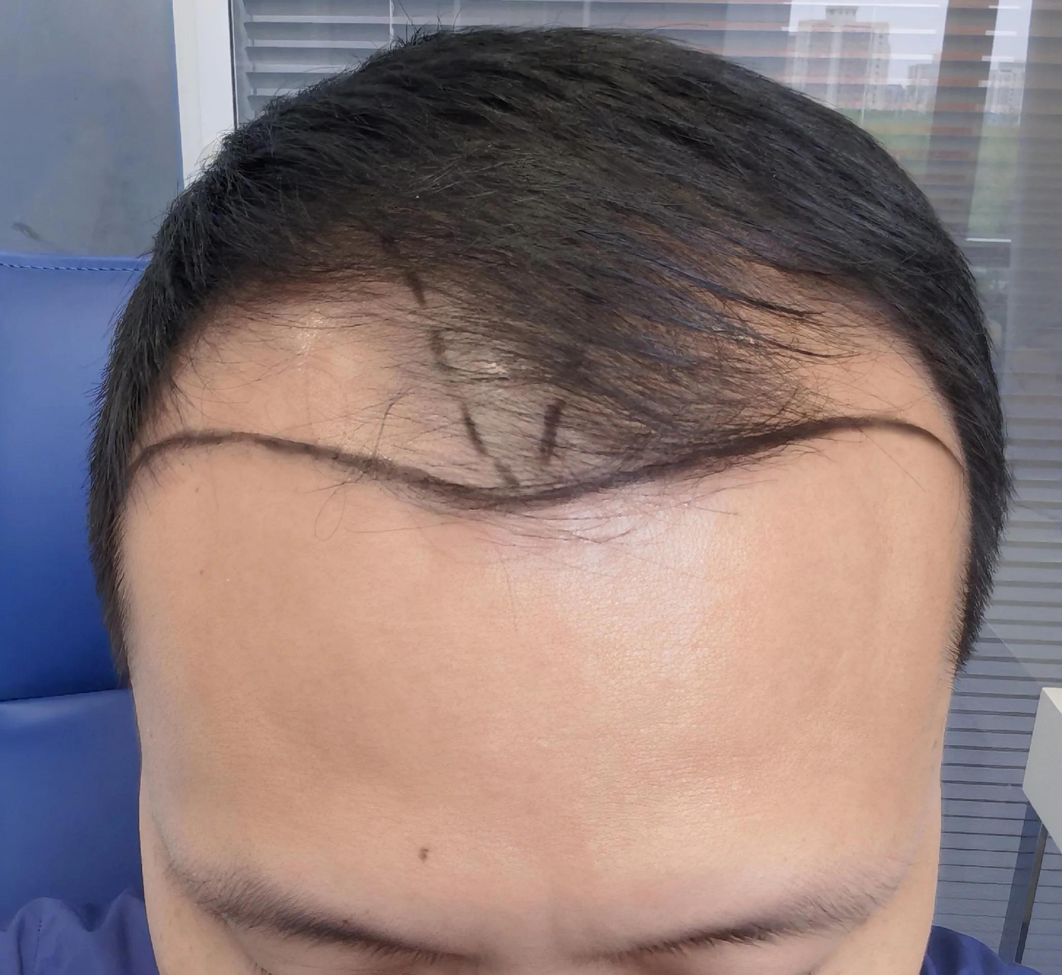 雄脱植发的亲身经历和感受,16000字讲述植发真实感受