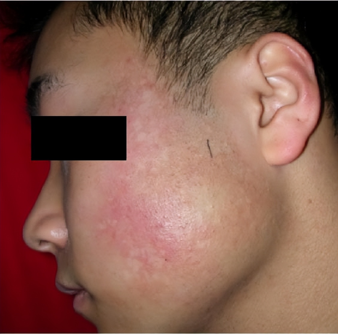 皮肤色素减退和白癜风有什么区别,白癜风是不是色素性皮肤病