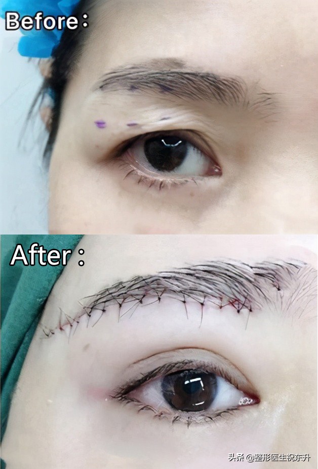 关于提眉手术的10个常见问题,提眉手术最简单的方式