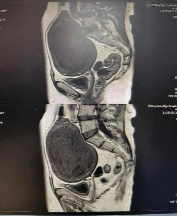 小切口解决大问题——兰大二院西固医院妇科成功完成腹腔镜下巨大子宫全切术