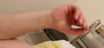 古派针灸,黄贵生针灸视频全集