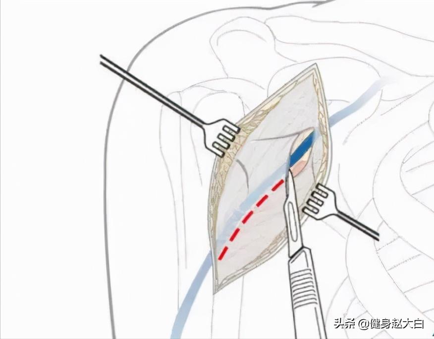 胸部和肩部训练,上胸和肩部分离度训练