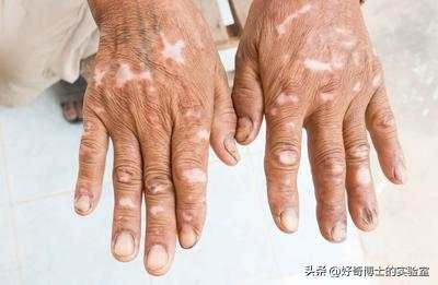 女生大腿外侧出现小条纹,为什么女生大腿上会有条纹